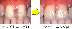 2.ホワイトニング