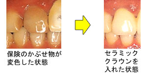 3.ラミネーベニア