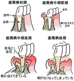 歯周病は痛みが無く進行する